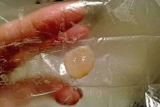 药物流产孕囊排出图片恶心到吐 胆小慎进！